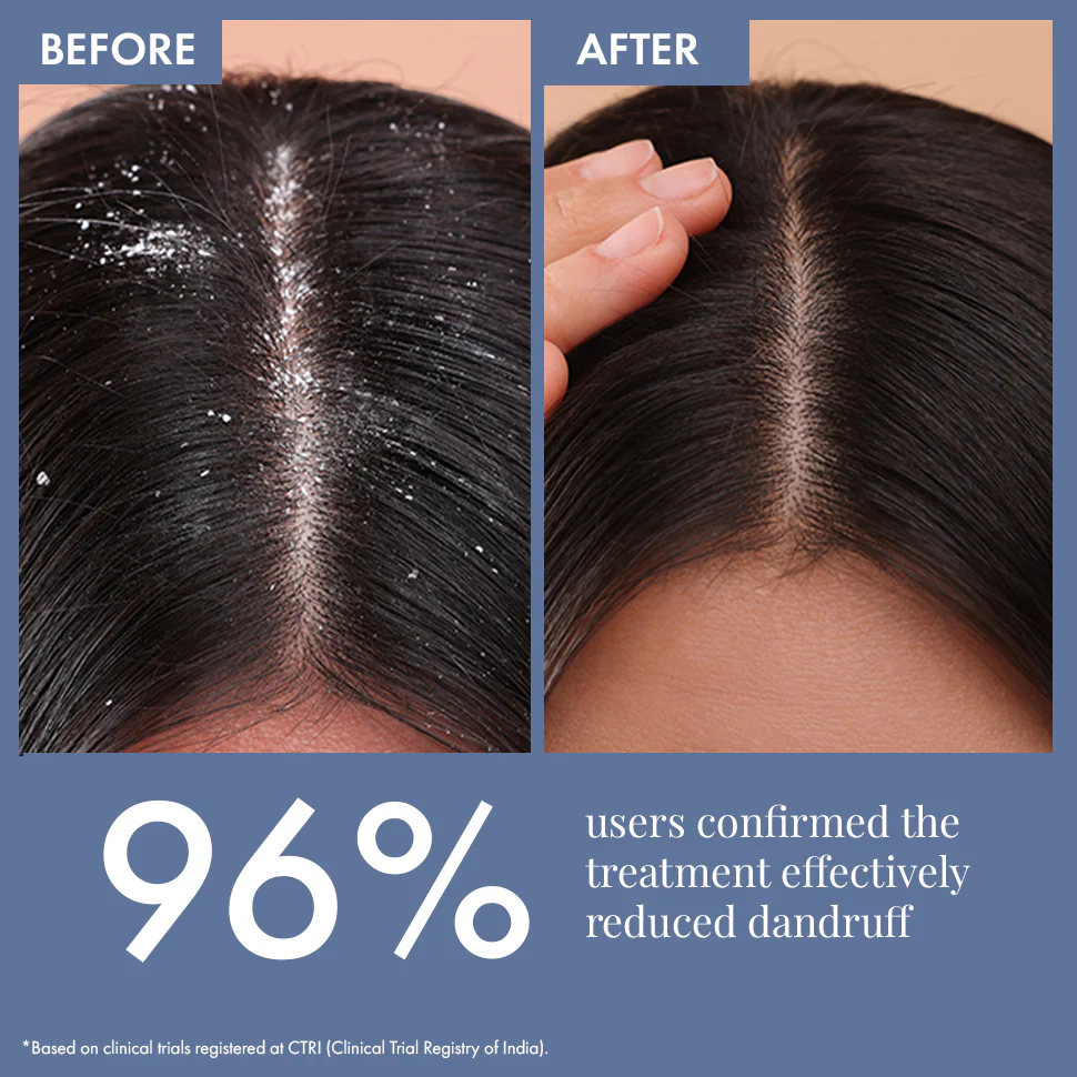 Dandruff Treatment Trial kit - Image 6