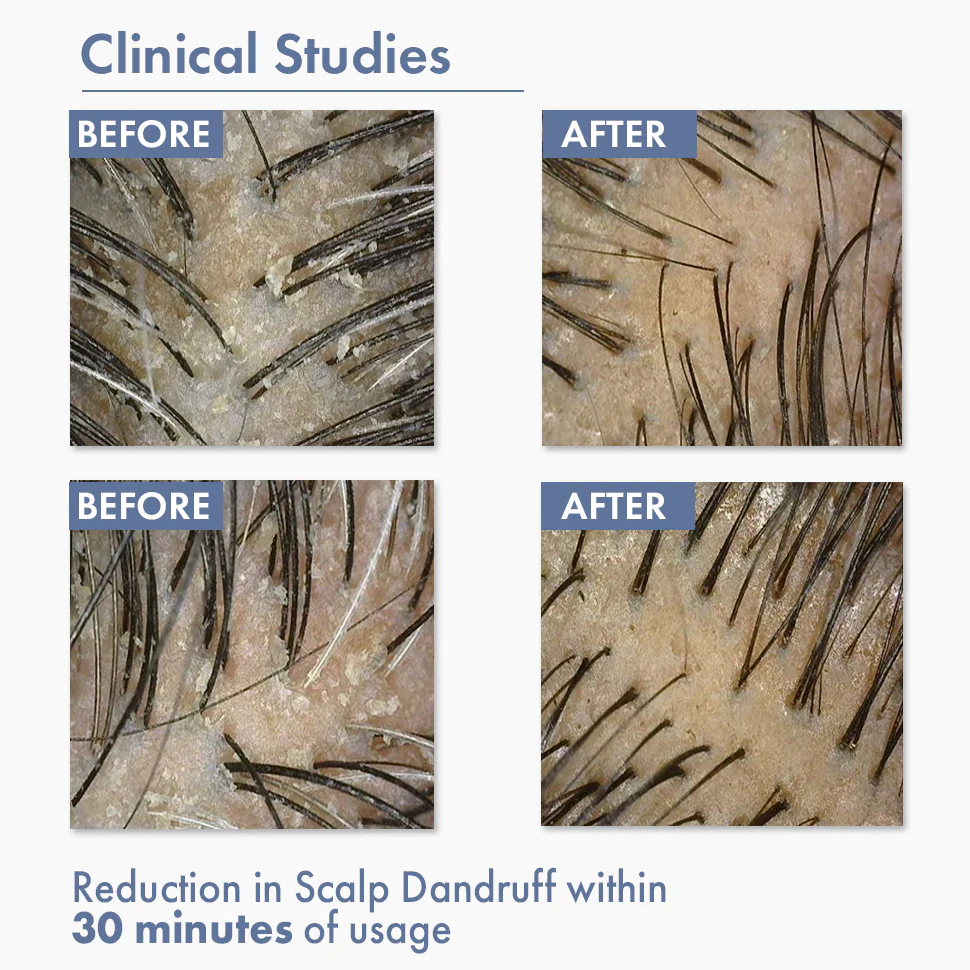 Dandruff Treatment Trial kit - Image 5